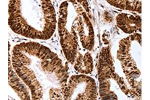 The image on the left is immunohistochemistry of paraffin-embedded Human colon cancer tissue using ABIN7193127(Map2 Antibody) at dilution 1/40, on the right is treated with synthetic peptide. (MAP2 Antikörper)