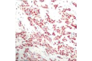 Immunohistochemistry of paraffin-embedded human breast carcinoma using Phospho-NFKB2-S866 antibody (ABIN2988214). (NFKB2 Antikörper  (pSer866))
