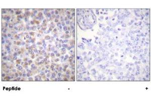 Immunohistochemical analysis of paraffin-embedded human breast carcinoma tissue using YWHAZ polyclonal antibody . (14-3-3 zeta Antikörper)