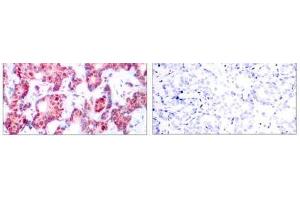 Immunohistochemical analysis of paraffin-embedded human breast carcinoma tissue using GATA-1 (phospho-Ser142) antibody (E011041). (GATA1 Antikörper  (pSer142))