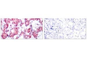 Immunohistochemical analysis of paraffin-embedded human breast carcinoma tissue using GATA-1 (phospho-Ser142) antibody (E011041). (GATA1 Antikörper  (pSer142))
