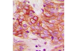 Immunohistochemical analysis of Calmodulin (pT80/S82) staining in human breast cancer formalin fixed paraffin embedded tissue section. (Calmodulin 1 Antikörper  (pSer80, pSer82))