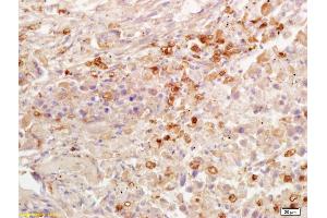Formalin-fixed and paraffin embedded human lung carcinoma labeled with Rabbit Anti AKR1A1 Polyclonal Antibody, Unconjugated (ABIN872733) at 1:200 followed by conjugation to the secondary antibody and DAB staining