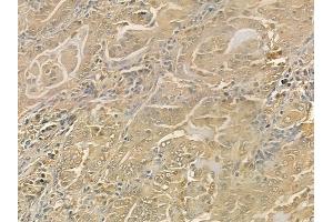 ABIN6265823 and ABIN6276506 at 1/100 staining human lung adenocarcinoma by IHC-P.
