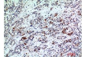 Immunohistochemistry (IHC) analysis of paraffin-embedded Human Breast Cancer, antibody was diluted at 1:200. (BATF3 Antikörper)