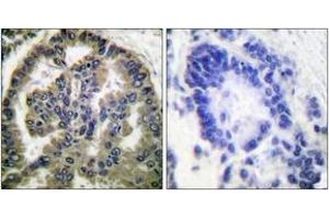 Immunohistochemistry analysis of paraffin-embedded human lung carcinoma tissue, using TGF beta2 Antibody. (TGFB2 Antikörper  (AA 361-410))