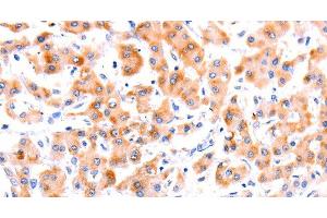 Immunohistochemistry of paraffin-embedded Human liver cancer tissue using Ephrin A1 Polyclonal Antibody at dilution 1:37 (Ephrin A1 Antikörper)