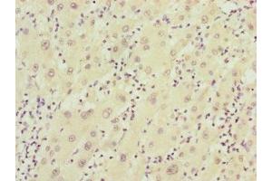 Immunohistochemistry of paraffin-embedded human liver cancer using ABIN7152411 at dilution of 1:100 (FBXO22 Antikörper  (AA 104-403))