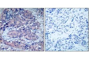 Immunohistochemical analysis of paraffin-embedded human breast carcinoma tissue, using SEK1/MKK4 (Ab-261) antibody (E021131). (MAP2K4 Antikörper)