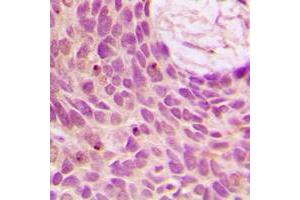 Immunohistochemical analysis of SENP1 staining in human breast cancer formalin fixed paraffin embedded tissue section. (SENP1 Antikörper  (N-Term))