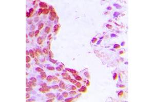 Immunohistochemical analysis of HIF1 beta staining in human breast cancer formalin fixed paraffin embedded tissue section.