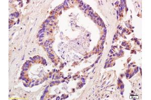 Formalin-fixed and paraffin embedded human colon carcinoma labeled with Anti-ADAMTS12 Polyclonal Antibody, Unconjugated (ABIN685792) at 1:200 followed by conjugation to the secondary antibody and DAB staining. (ADAMTS12 Antikörper  (AA 301-450))