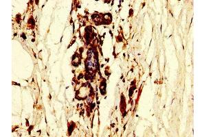 IHC image of ABIN7150454 diluted at 1:300 and staining in paraffin-embedded human breast cancer performed on a Leica BondTM system.