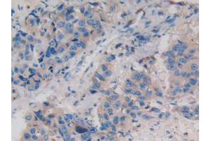 IHC-P analysis of Human Breast Cancer Tissue, with DAB staining. (WNT3A Antikörper  (AA 19-352))