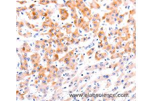 Immunohistochemistry of Human thyroid cancer using EFNA1 Polyclonal Antibody at dilution of 1:37 (Ephrin A1 Antikörper)