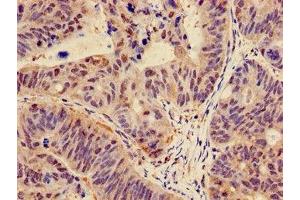 Immunohistochemistry of paraffin-embedded human colon cancer using ABIN7146988 at dilution of 1:100 (CTNND1 Antikörper  (AA 482-605))