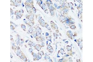 Immunohistochemistry of paraffin-embedded Human breast cancer using SRC Polyclonal Antibody at dilution of 1:100 (40x lens). (Src Antikörper)