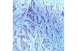 Immunohistochemical analysis of paraffin- embedded human breast carcinoma tissue using ASK1 (Ab-83) Antibody (E022058). (ASK1 Antikörper)
