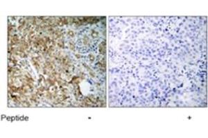 Immunohistochemical analysis of paraffin-embedded human breast carcinoma tissue using IGF1R polyclonal antibody  . (IGF1R Antikörper)