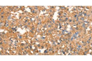 Immunohistochemistry of paraffin-embedded Human thyroid cancer using CRELD1 Polyclonal Antibody at dilution of 1:40 (CRELD1 Antikörper)
