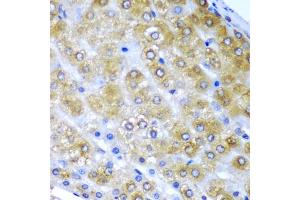 Immunohistochemistry of paraffin-embedded human liver cancer using BMF antibody (ABIN6290093) at dilution of 1:200 (40x lens). (BMF Antikörper)