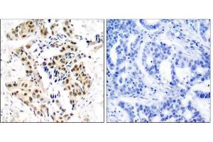 Immunohistochemical analysis of paraffin-embedded human breast carcinoma tissue using ATM (phospho-Ser1981) antibody (E011122). (ATM Antikörper  (pSer1981))