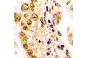Immunohistochemical analysis of JUND staining in human lung cancer formalin fixed paraffin embedded tissue section. (JunD Antikörper  (C-Term))