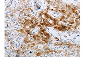 The image on the left is immunohistochemistry of paraffin-embedded Human lung cancer tissue using ABIN7191702(NPY2R Antibody) at dilution 1/20, on the right is treated with synthetic peptide. (NPY2R Antikörper)