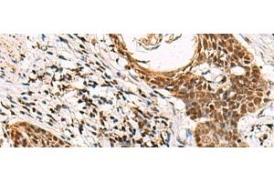 Immunohistochemistry of paraffin-embedded Human esophagus cancer tissue using GABPB1 Polyclonal Antibody at dilution of 1:70(x200) (GABPB1 Antikörper)