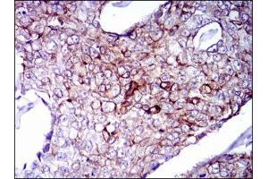 Immunohistochemical analysis of paraffin-embedded breast cancer tissues using CK5 antibody with DAB staining. (Cytokeratin 5 Antikörper)