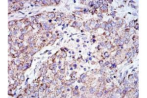 Immunohistochemical analysis of paraffin-embedded lung cancer tissues using PHB mouse mAb with DAB staining. (Prohibitin Antikörper)