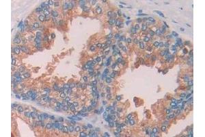 Detection of CBG in Human Prostate Tissue using Polyclonal Antibody to Corticosteroid Binding Globulin (CBG) (SERPINA6 Antikörper  (AA 218-378))