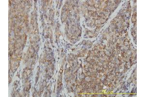 Immunoperoxidase of monoclonal antibody to RHOA on formalin-fixed paraffin-embedded human lymphoma tissue. (RHOA Antikörper  (AA 1-193))