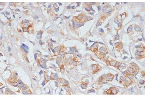 Immunohistochemistry of paraffin-embedded Human breast cancer using DLL1 Polyclonal Antibody at dilution of 1:100 (40x lens). (DLL1 Antikörper)