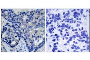 Immunohistochemical analysis of paraffin-embedded human breast carcinoma tissue, using Pyk2 (phospho-Tyr402) antibody (E011216). (PTK2B Antikörper  (pTyr402))