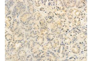 ABIN6259378 and ABIN6276139 at 1/100 staining human renal cell carcinoma by IHC-P.