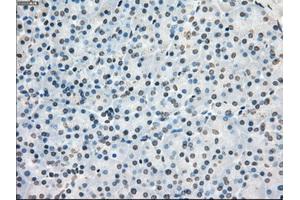 Immunohistochemical staining of paraffin-embedded Adenocarcinoma of colon tissue using anti-PORmouse monoclonal antibody. (POR Antikörper)