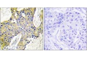 Immunohistochemistry analysis of paraffin-embedded human breast carcinoma tissue, using IARS2 Antibody. (IARS2 Antikörper  (AA 71-120))