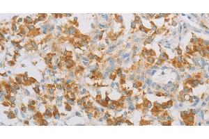 Immunohistochemistry of paraffin-embedded Human thyroid cancer tissue using REN Polyclonal Antibody at dilution 1:40 (Renin Antikörper)