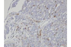 IHC-P Image Immunohistochemical analysis of paraffin-embedded human serous ovarian cancer, using ST3GAL1, antibody at 1:100 dilution.