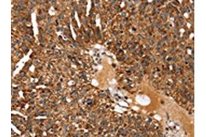 The image on the left is immunohistochemistry of paraffin-embedded Human breast cancer tissue using ABIN7129957(KCNH6 Antibody) at dilution 1/30, on the right is treated with fusion protein. (KCNH6 Antikörper)