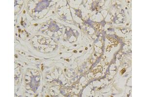 Immunohistochemistry of paraffin-embedded human mammary cancer using SLC2A1 antibody (ABIN5997113) at dilution of 1/100 (40x lens).