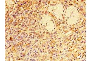 Immunohistochemistry of paraffin-embedded human gastric cancer using ABIN7167377 at dilution of 1:100 (RAB7A Antikörper  (AA 110-177))