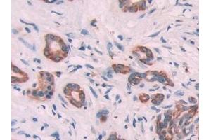 Detection of KRT6C in Human Pancreatic cancer Tissue using Polyclonal Antibody to Keratin 6C (KRT6C) (Keratin 6C Antikörper  (AA 163-482))