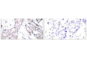 Immunohistochemical analysis of paraffin- embedded human breast carcinoma tissue using STAT3 (phospho-Ser727) antibody (E011046). (STAT3 Antikörper  (pSer727))