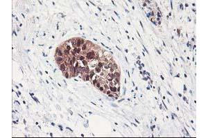 Immunohistochemical staining of paraffin-embedded Adenocarcinoma of Human breast tissue using anti-NIF3L1 mouse monoclonal antibody. (NIF3L1 Antikörper)