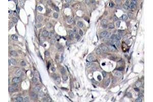 Immunohistochemistry analyzes of HSP27 antibody in paraffin-embedded human breast carcinoma tissue. (HSP27 Antikörper)