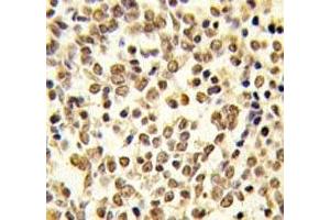 IHC analysis of FFPE human kideny carcinoma tissue stained with ERK5 antibody (MAPK7 Antikörper  (AA 776-805))