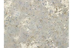 ABIN6255789 and ABIN6267123 at 1/100 staining human melanoma by IHC-P.