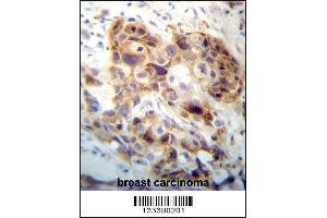 PI15 Antibody immunohistochemistry analysis in formalin fixed and paraffin embedded human breast carcinoma followed by peroxidase conjugation of the secondary antibody and DAB staining.
